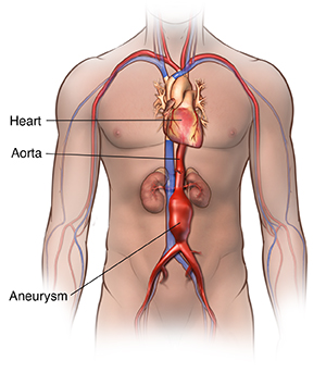 Front view of body showing abdominal aortic aneurysm.