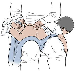 Baby being held face down on lap while rectal thermometer is inserted.