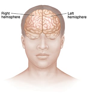 Front view of head and brain, with labels showing right hemisphere and left hemisphere.