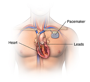 Front view of male chest showing pacemaker.