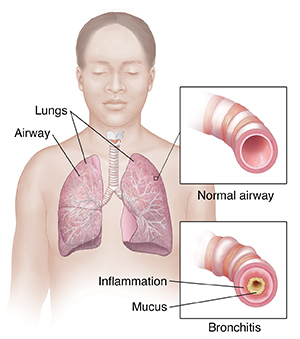 Front view of person, showing respiratory system. Insets show normal airway and airway with bronchitis.