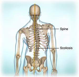 View of the skeleton showing a curved spine, known as scoliosis