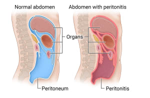 Normal abdomen showing normal peritoneum surrounding the abdomen and organs. Next to it, shows an abdomen with peritonitis, where the peritoneum that surrounds the abdomen and organs is red and inflammed.