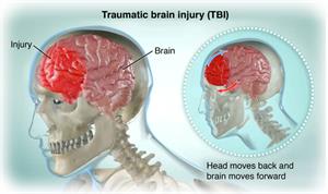 Image of skull and brain showing head moving back and brain moving forward causing brain injury.