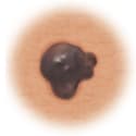 Skin cancer showing asymmetry.