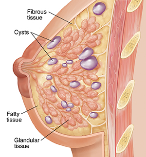 Side view cross section of breast showing glandular, fibrous, and fatty tissue and multiple cysts throughout breast.
